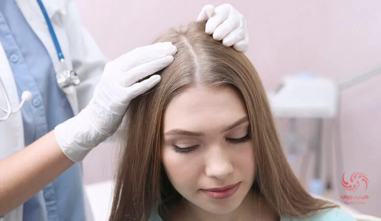 متخصصین پوست معمولاً با بررسی علائم می توانند به راحتی ریزش موی سکه ای را تشخیص دهند.