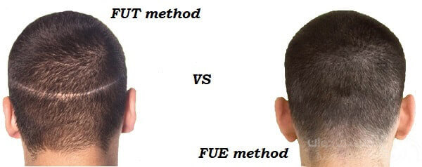 تفاوت دو متد FUT و FUEبا همدیگر