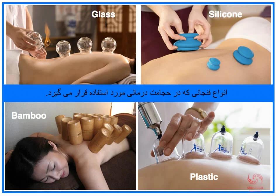 در حجامت درمانی از انواع فنجان های شیشه ای، سیلیکونی، پلاستیکی و حتی چوب های بامبو استفاده می شود.