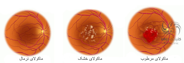 انواع تحلیل ماکولای چشم