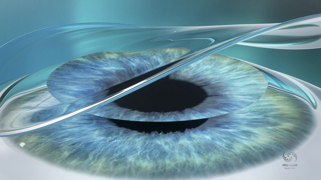 جراحی لازک یکی از رایج ترین جراحی های چشم برای رفع مشکل بینایی است