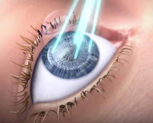 جراحی چشم پی آر کی (PRK) یکی از انواع جراحی ها برای اصلاح بینایی است