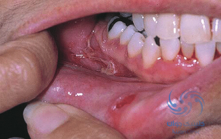 ولگاریس ابتدا با ایجاد تاول در دهان شروع می شود.