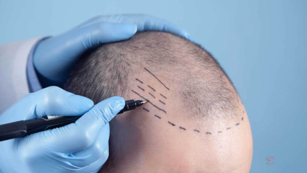 این روش بیشتر برای درمان ریزش مو در قسمت جلوی سر مفید است.