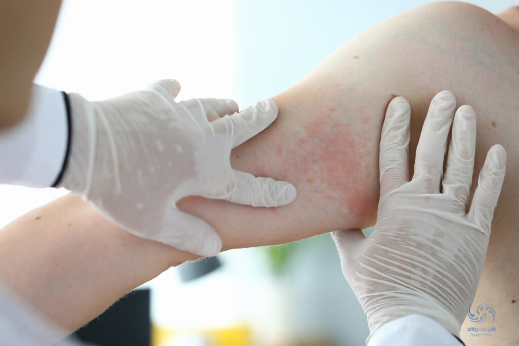 این بیماری چگونه توسط متخصص پوست تشخیص داده می شود ؟