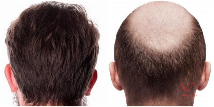 افزایش رشد و ظاهر طبیعی مو پس از آن