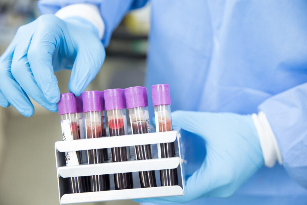 آزمایش خون می تواند یکی از راه های موثر در تشخیص بیماری های روماتیسمی باشد.