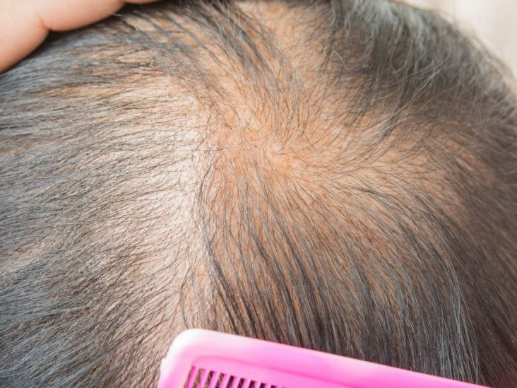 با بالا رفتن سن موها کمتر متراکم هستند زیرا دچار ریزش می شوند.