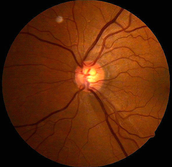 در گلوکوم با فشار طبیعی، فشار چشم افزایش قابل توجهی ندارد و آسیب به عصب بینایی در اثر ترکیبی از عوامل ایجاد می شود.