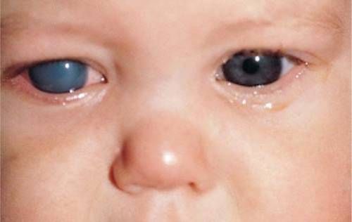 این بیماری در نوزادان زمانی رخ می دهد که کانال های تخلیه چشم در دوران بارداری نامناسب یا ناقص رشد کند.