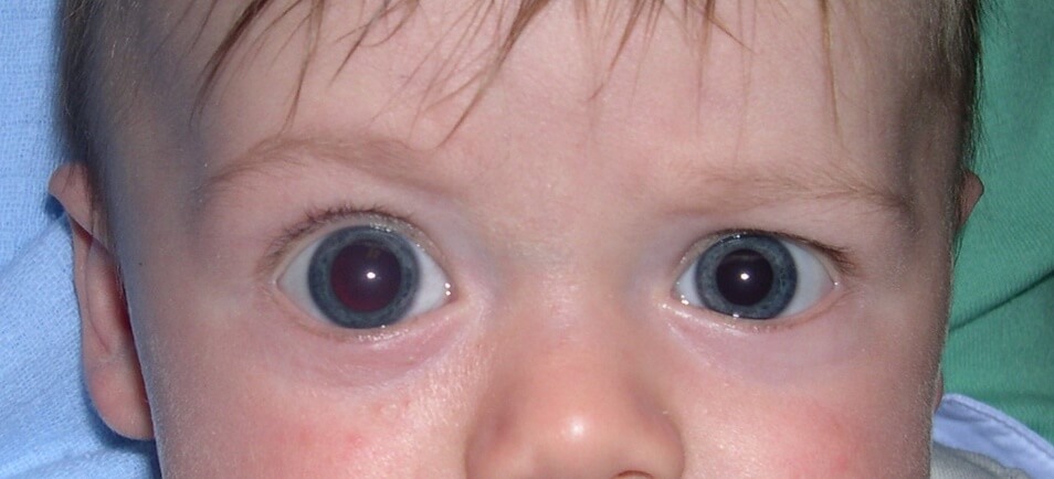 بزرگ شدن یک چشم یا هر دو چشم (بوفتالموس) بر اثر گلوکوم مادرزادی