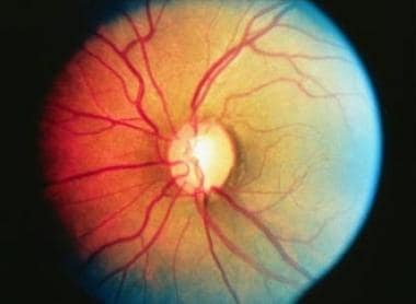 اگر داروهای تجویزی و قطره چشم فشار چشم را به اندازه کافی کاهش ندهند، چشم پزشک ممکن است نوعی روش لیزری را توصیه کند.