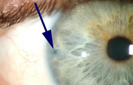 لیزر pi و سوراخ ایجاد شده در عنبیه جهت کاهش فشار چشم